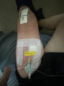 So after 60 my knees went pffft no mas.  This is my leg day 3 after knee replacement surgery.  Knee pain relief for seniors who travel using ageless knees is how I am trying to keep the other knee healthy.
